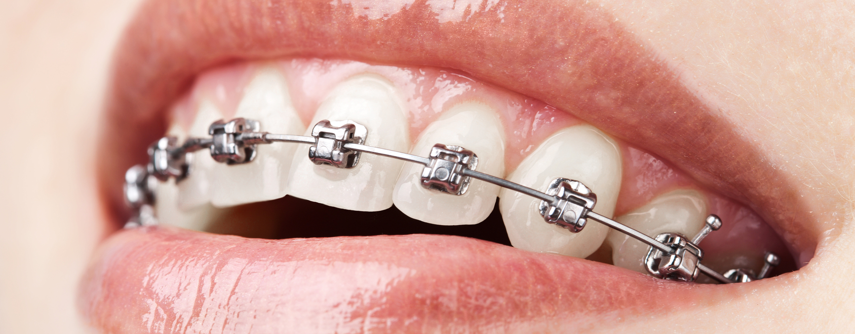 Aparat dentar Andra Dent Estetic
